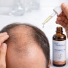 Minoxidil 5% Galenico – Lozione Anticaduta per Ricrescita Capelli
