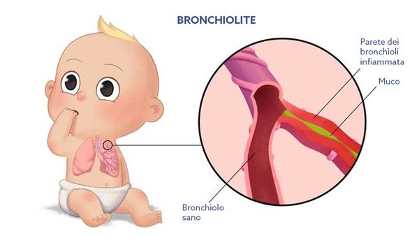bronchiolite neonati e bambini