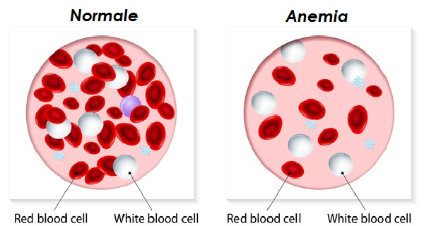 l'anemia da carenza di ferro può essere combattuta con integratori di ferro sucrosomiale