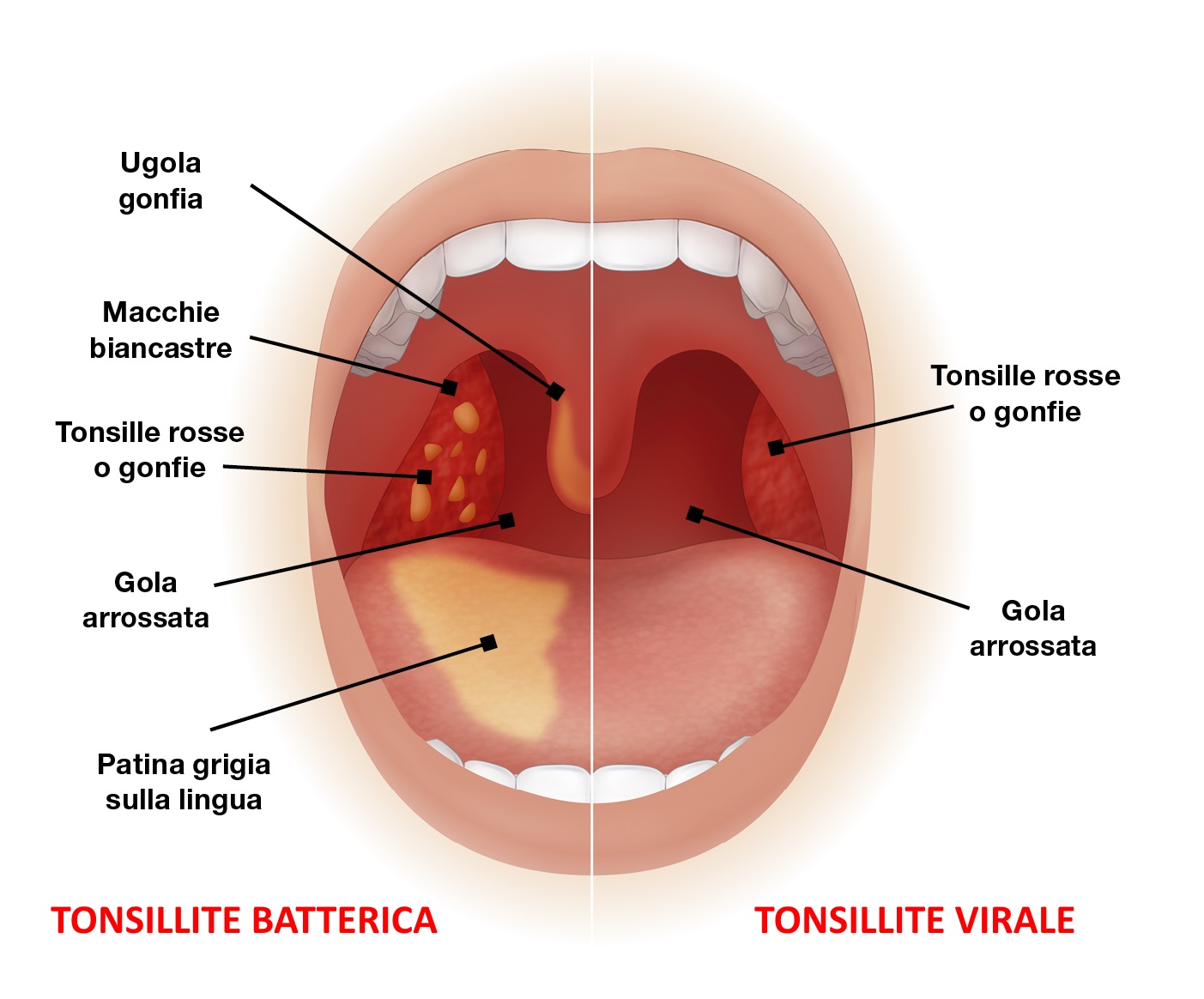 tonsille infiammate rimedi