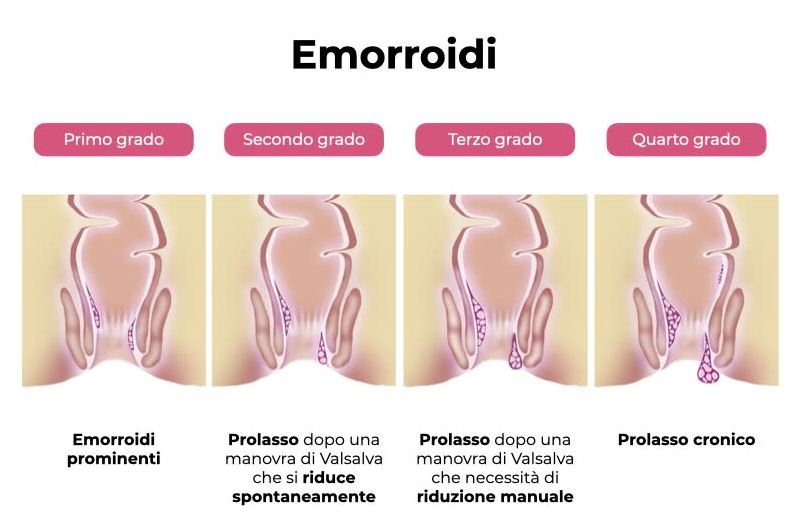 rimedi emorroidi