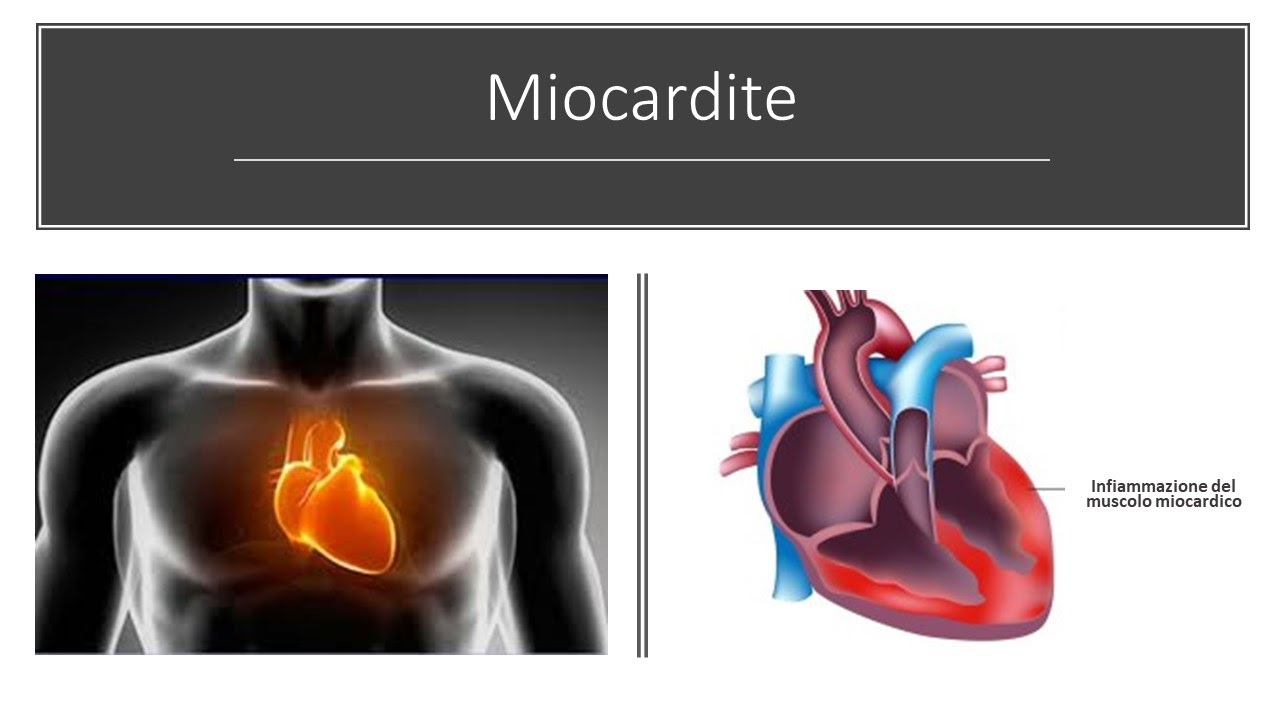 differenza tra cuore sano e cuore malato di miocardite 